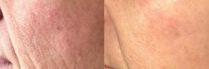 Anti Ageing Facials Estetika Clinic Anti Ageing Facials Estetika Clinic