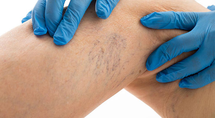 Thread Vein Removal in Norwich