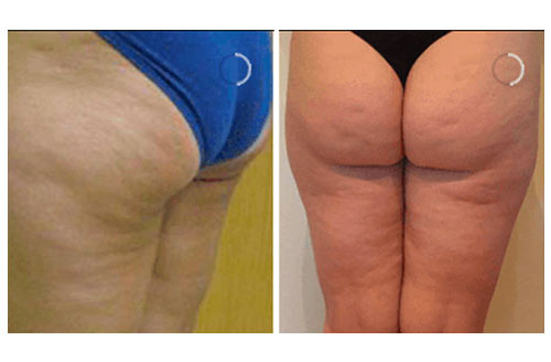 Cellulite Treatment Norwich