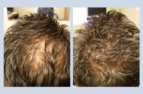 Laser Hair regrowth after before