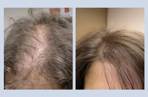 Laser Hair After Regrowth