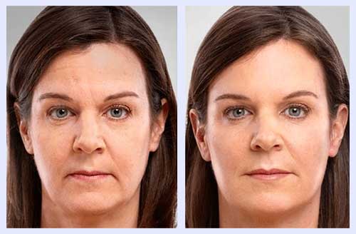 Mesotherapy Norwich Skin Rejuvenation Estetika Clinic