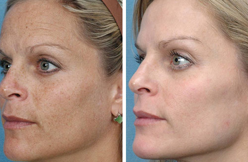 Skin Rejuv Before & After 2