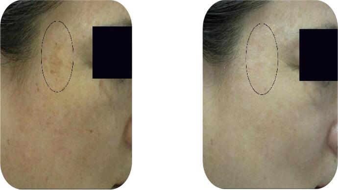 Skin difference after CO2 Laser Resurfacing