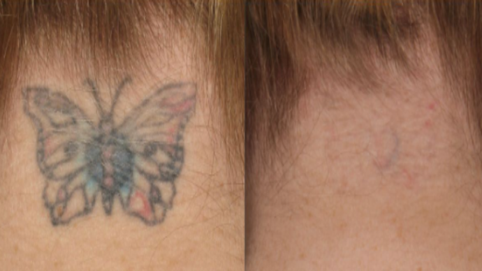 Laser tattoo removal 1