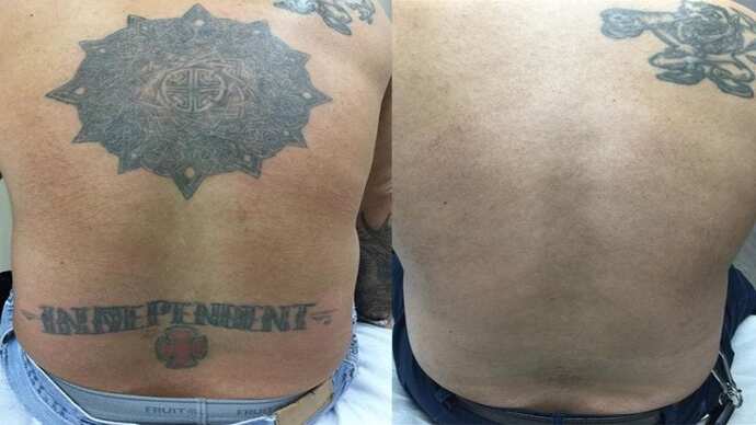 Laser tattoo removal 2