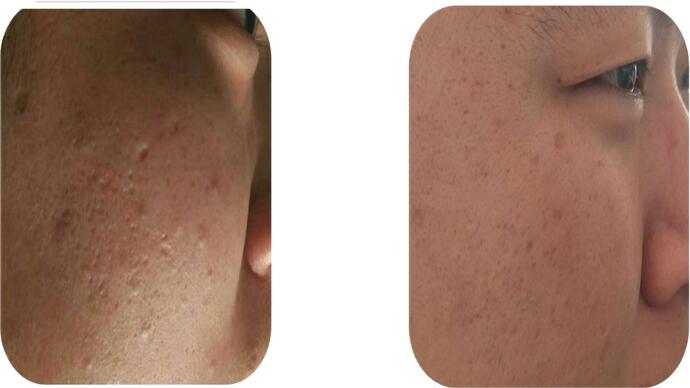 Before and after with co2 Laser Resurfacing