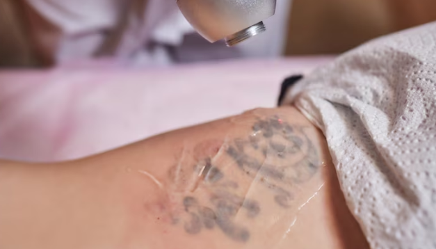 Common things people must know about laser tattoo removal